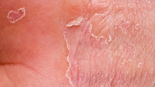 皮肤爱出油还脱皮？快往菜篮加这5样，便宜又管饱