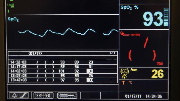 焦虑症会引起心律失常