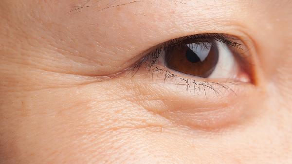 如何消除眼角鱼尾纹