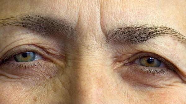 如何去除手上皱纹