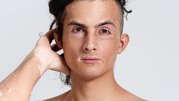 怎么调整白癜风患者心理