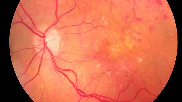 脑血管造影是什么检查