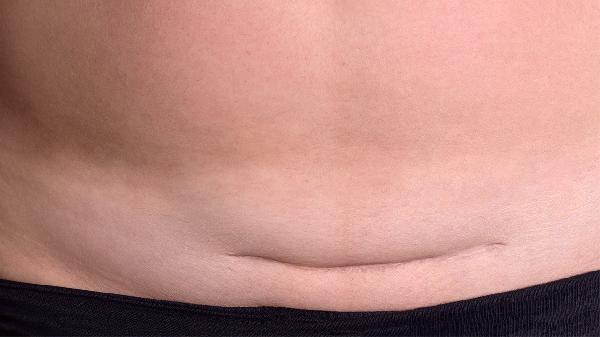 剖腹产来月经越早好吗