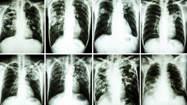 清肺化痰丸可以治疗什么疾病