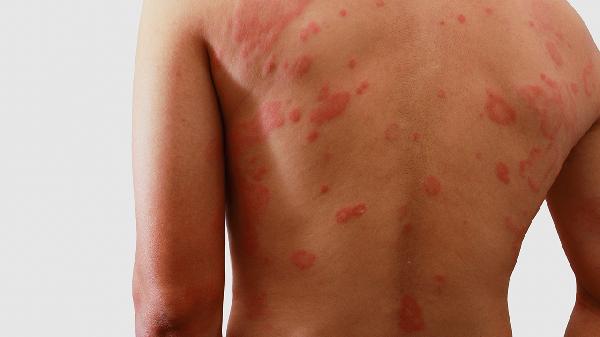 荨麻疹丸适用人群有哪些