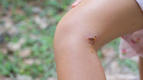 阴囊渗液结痂蜕皮反复怎么办