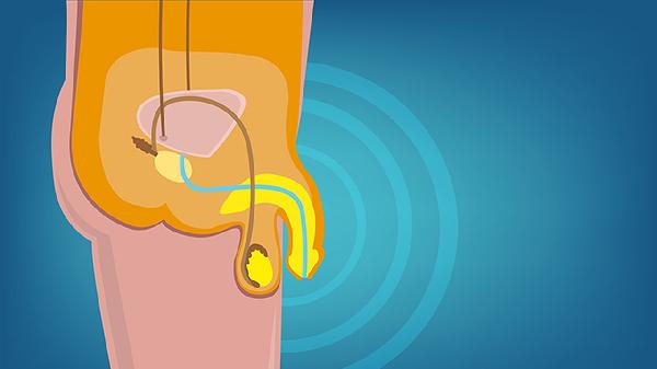 阴茎毛囊炎的原因有哪些