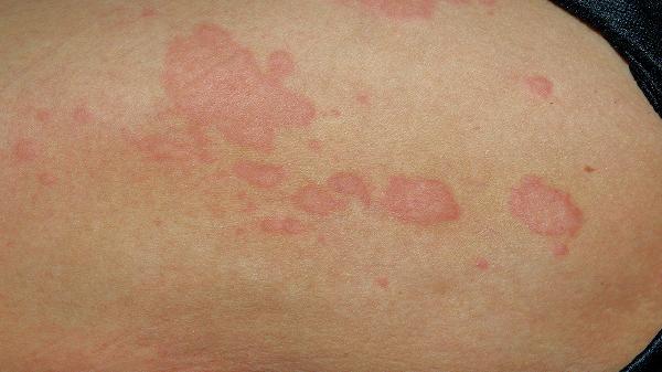 春季过敏性皮肤病