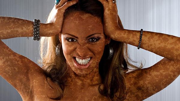 皮肤春季过敏如何治疗好得快