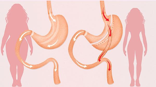 月瘦20斤的代价：你的内脏在求救！