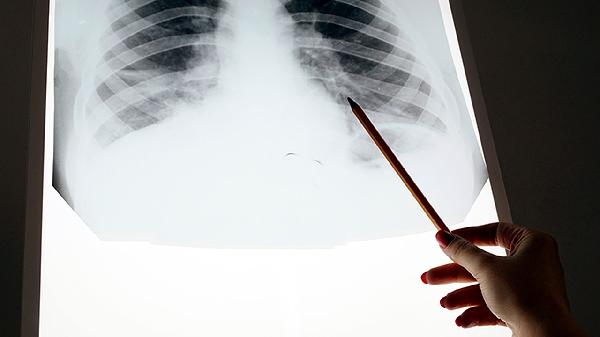 肺病患者贪辣实录：每顿加辣半年后，身体开始罢工…