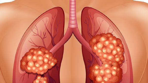 肿瘤要做什么检查才能查出来