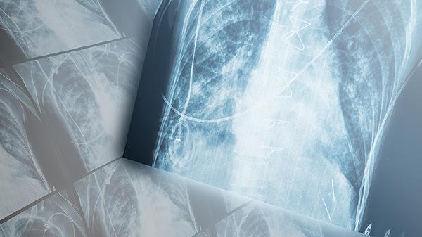 饿出来的“瘦”有多可怕？医生都急了！