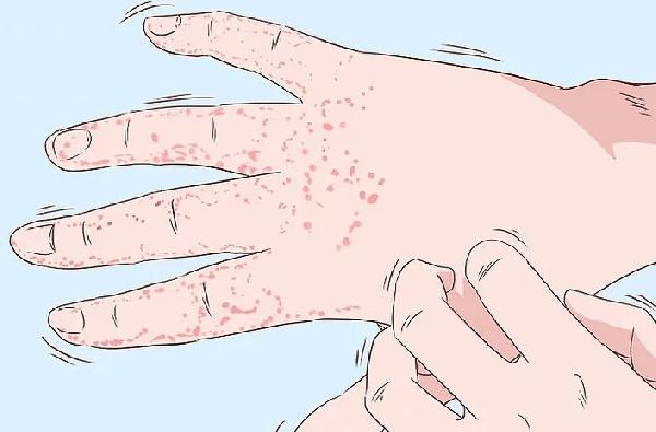 有梅毒的治疗方法