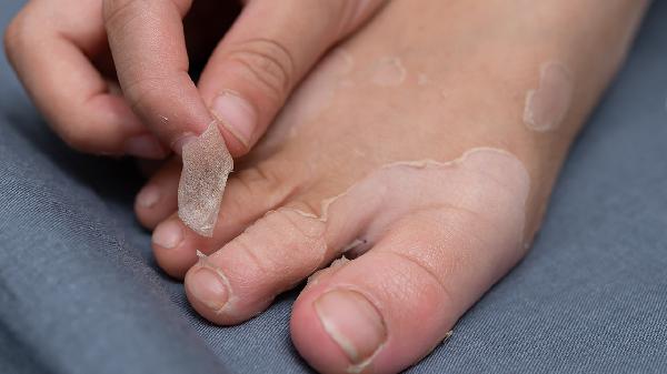 阴囊瘙痒脱皮怎么回事