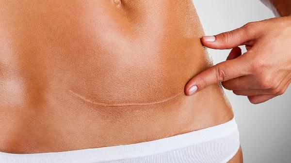 剖腹产哺乳期两个月来月经正常吗