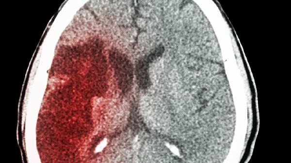 宝宝外伤导致脑出血后遗症