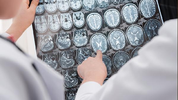 多发腔隙性脑梗死软化灶怎么回事严重