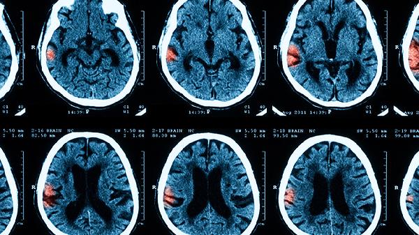 怎么检查脑膜炎