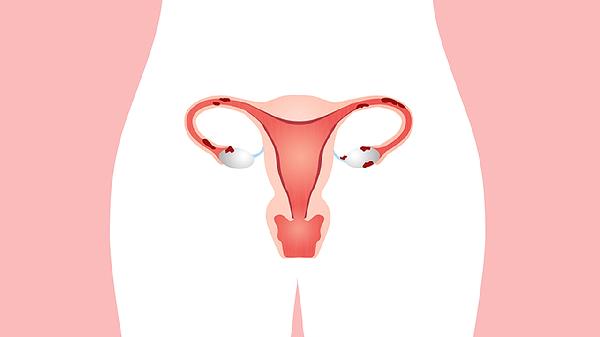 有宫腔粘连顺利生下宝宝吗