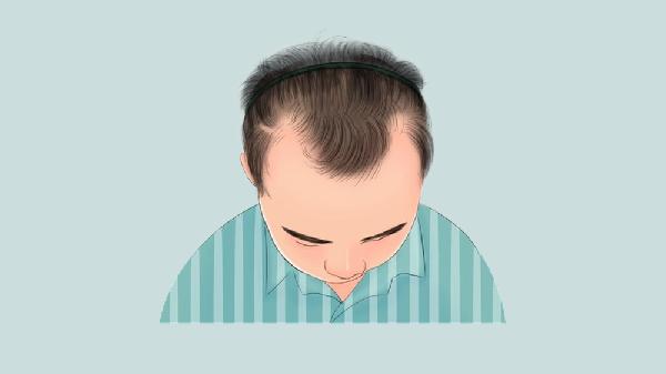 发际线悄悄后移，生活里有哪些习惯在推波助澜？