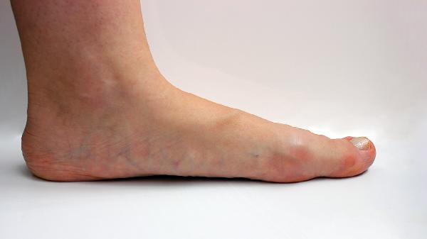 治疗真菌脚气最好的药