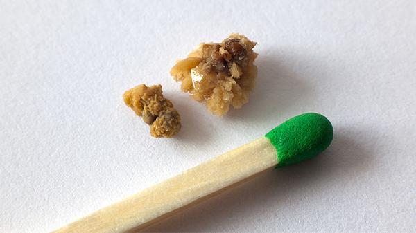 治疗结石病的草药有什么