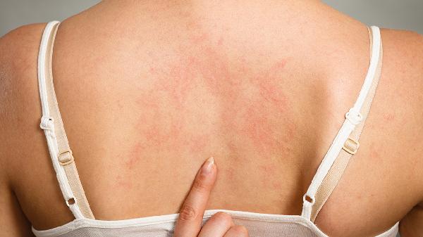 吃退烧药会把疹子憋回去吗