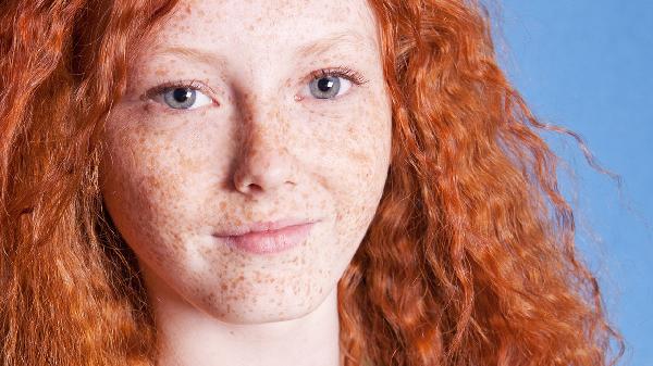 二氧化碳祛斑是一次性去除吗